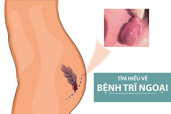 Tiếp nhận và điều trị hiệu quả nhiều ca bệnh trĩ