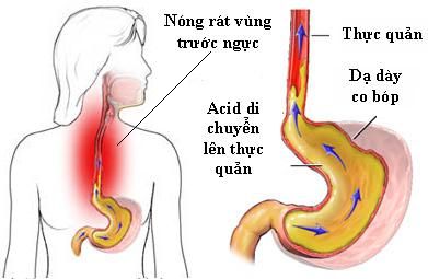 dieu-tri-trao-nguoc-da-day-bao-lau-thi-khoi