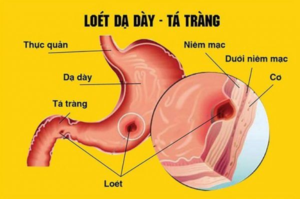 dieu-tri-viem-loet-da-day-trong-bao-lau