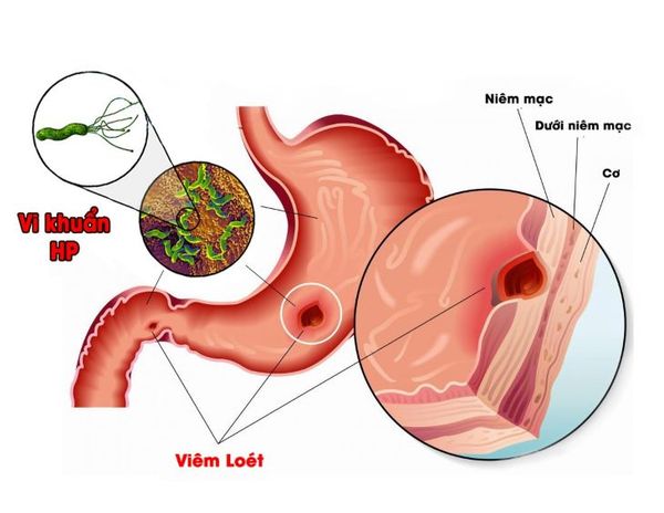 dieu-tri-viem-loet-da-day-trong-bao-lau-