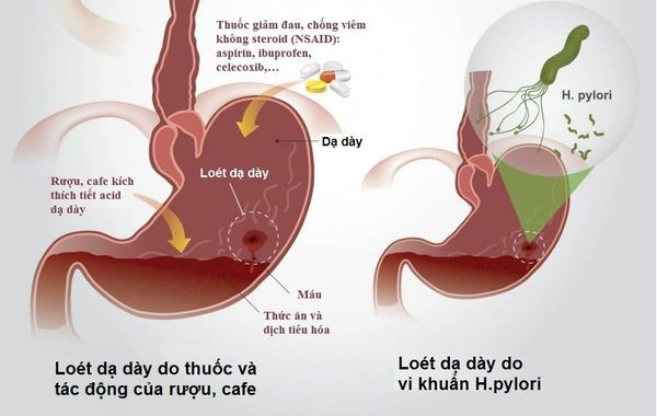 viem-loet-da-day-nen-dung-thuoc-gi