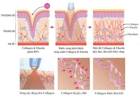 Bước sóng cao tần RF tác động sâu vào 3 lớp biểu bì, hạ bì, mô kích thích liên kết và tăng sinh collagen cho da săn chắc, mịn màng (*).