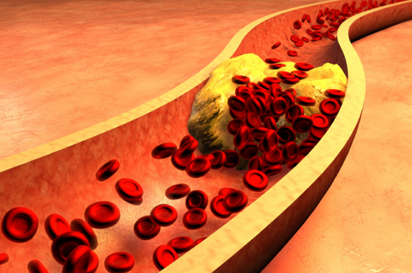 Tác hại của lượng cholesterol không kiểm soát