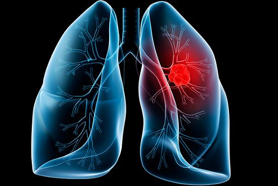 Ung thư phổi, bệnh nguy hiểm khó phát hiện sớm