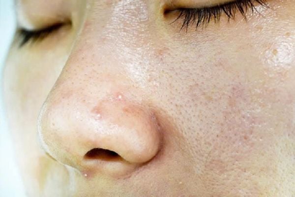 có nên đi spa nặn mụn không​