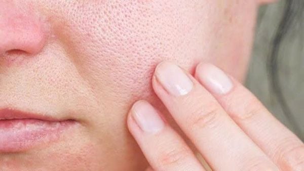 có nên đi spa nặn mụn không​