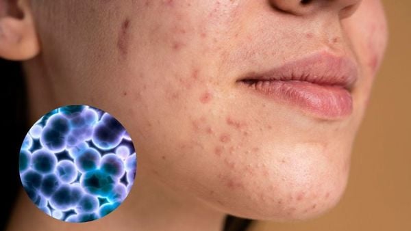 có nên đi spa nặn mụn không​