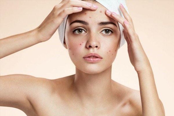 có nên đi spa nặn mụn không​