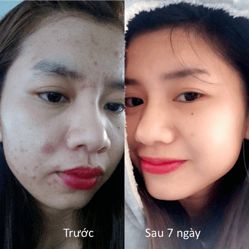 Kem trị mụn hiệu quả Medi Acne