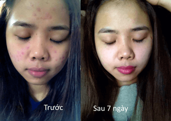 Kem trị mụn hiệu quả Medi Acne