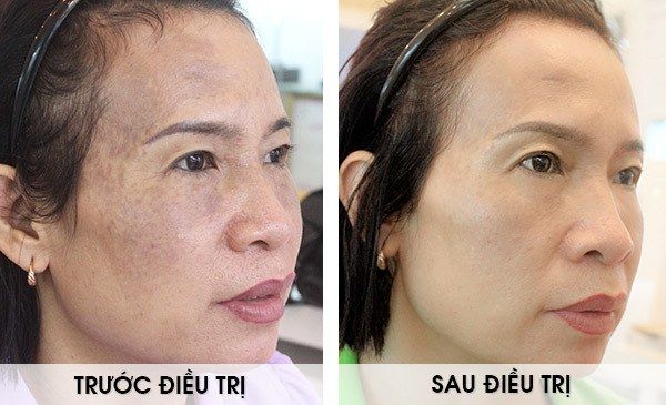 Kem trị nám, tàn nhang Medi Melasma