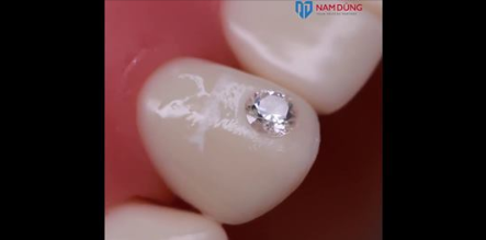 KỸ THUẬT ĐÍNH ĐÁ RĂNG BẰNG MŨI KHOAN MANI