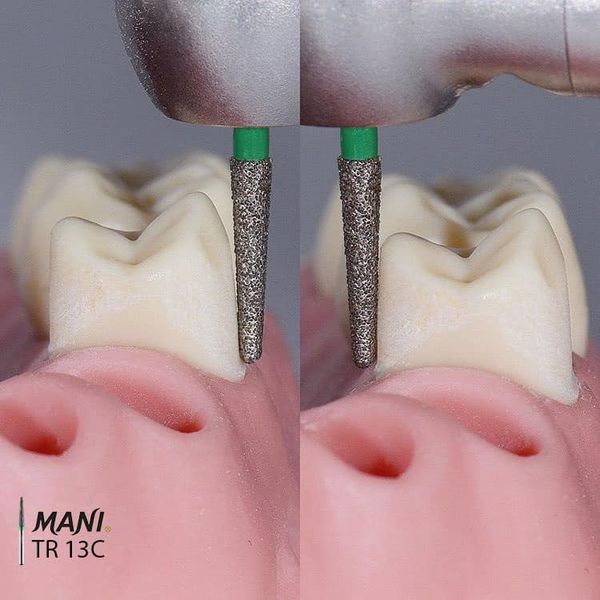 MŨI KHOAN MANI TR 13C & TR 26F SẴN SÀNG HOÀN THIỆN CÙI RĂNG