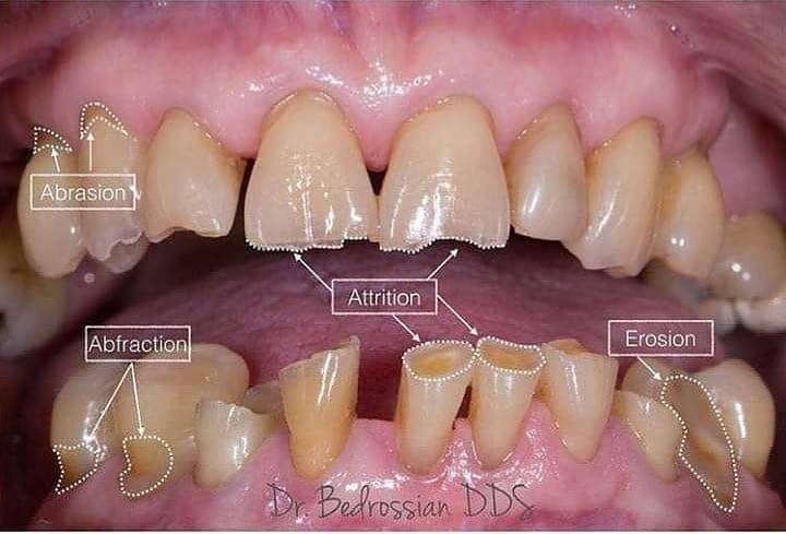 MINH HỌA CÁC DẠNG MÒN NGÓT CỔ RĂNG