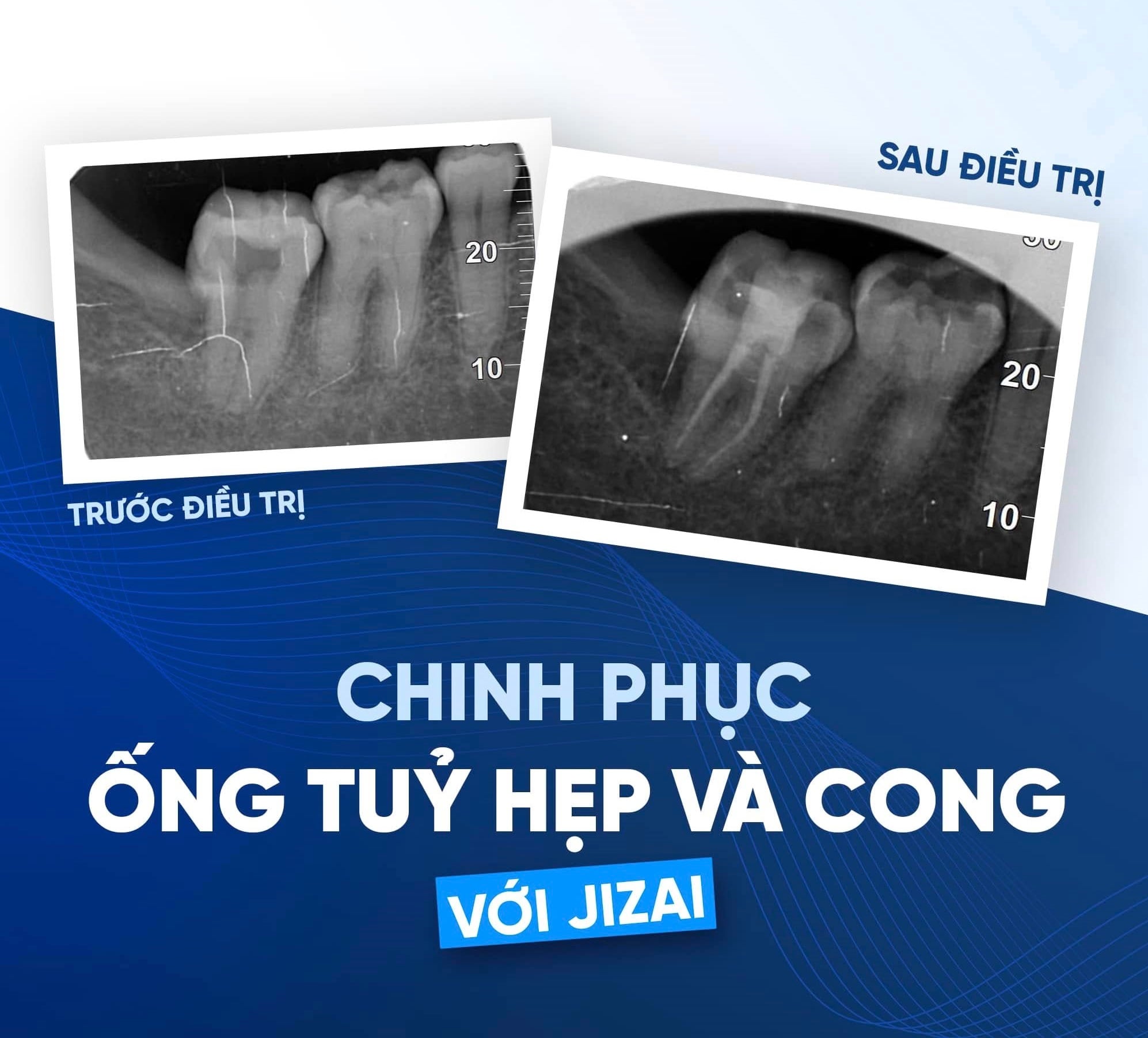 Chinh Phục Ống Tủy Hẹp và Cong: Giải Pháp Từ Jizai