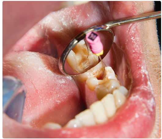 XỬ TRÍ ỐNG TỦY KHẤC TRONG ĐIỀU TRỊ NỘI NHA