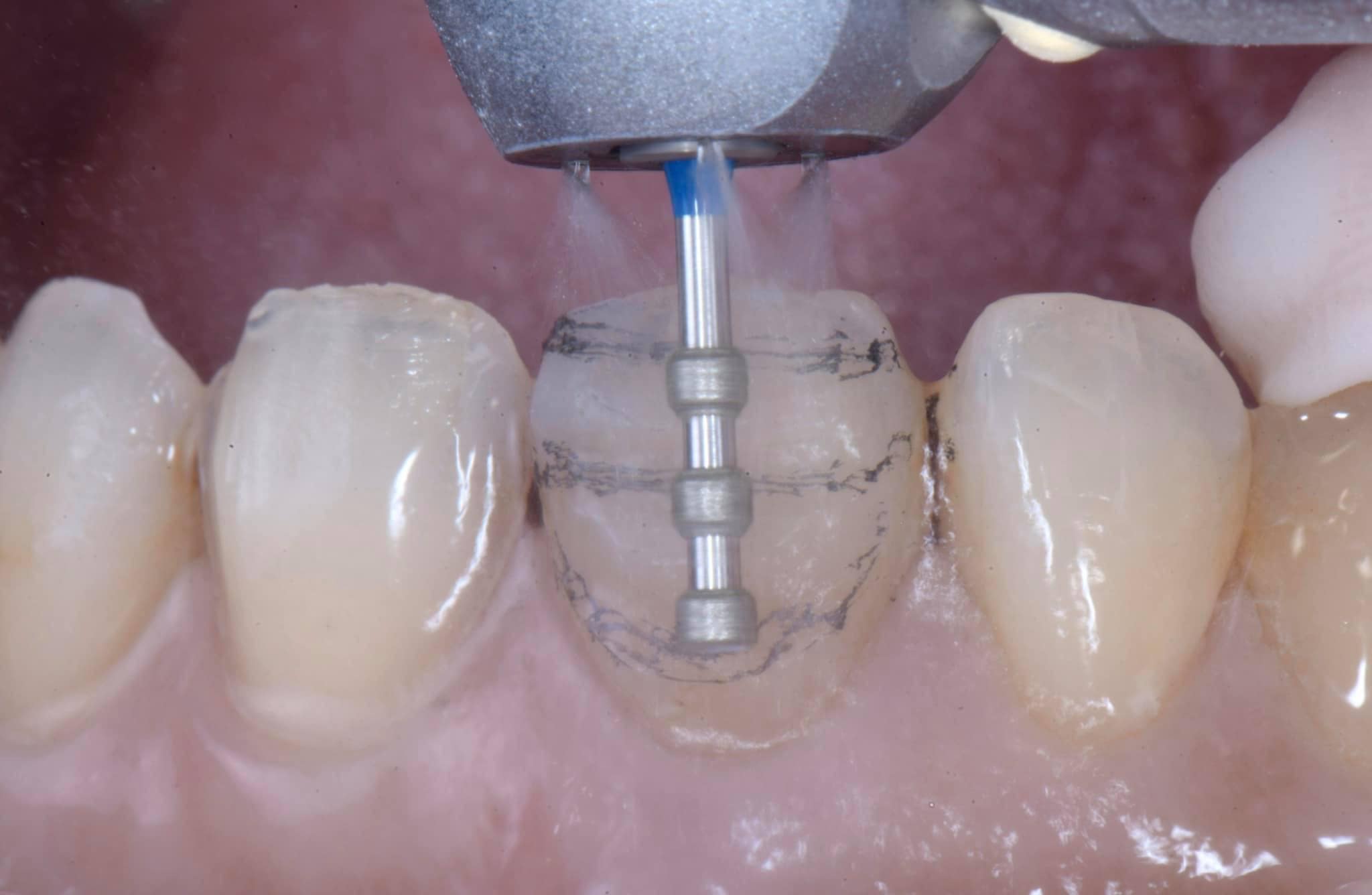 LÀM THẾ NÀO ĐỂ KIỂM SOÁT ĐỘ DÀY VENEER TỐT NHẤT?