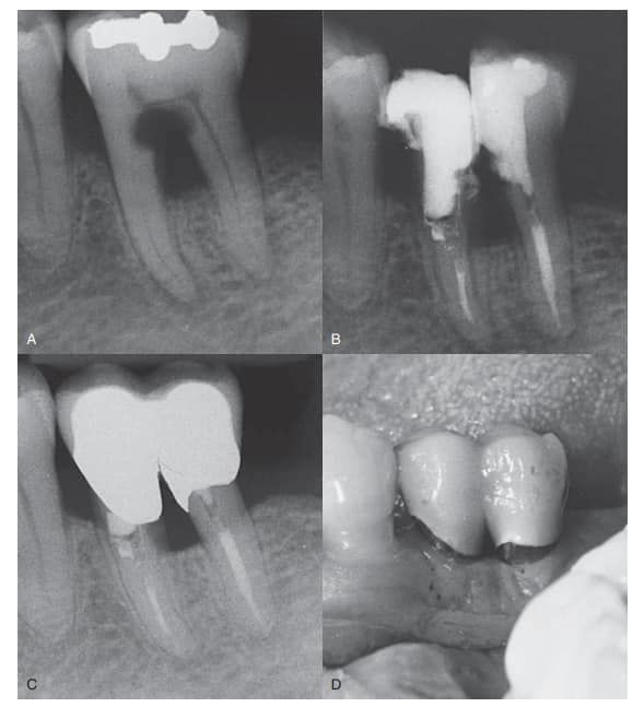 TRƯỜNG HỢP ĐIỀU TRỊ TỦY VÀ CHIA THÂN CHÂN RĂNG