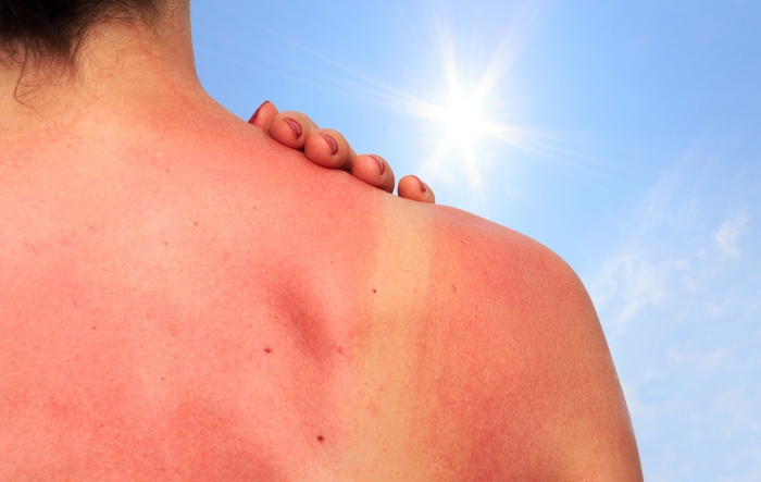 Da bị cháy nắng là hiện tượng da bị ửng đỏ do tiếp xúc quá lâu dưới ánh nắng mặt trời