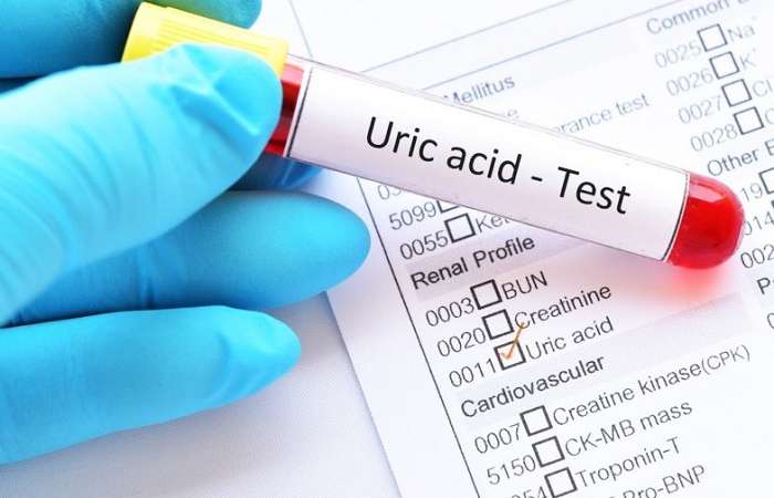 Acid uric là sản phẩm chuyển hóa của cơ thể