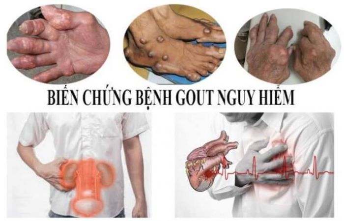 Giai đoạn cuối của bệnh gout có thể làm hạn chế các hoạt động và làm biến chứng thận, tim