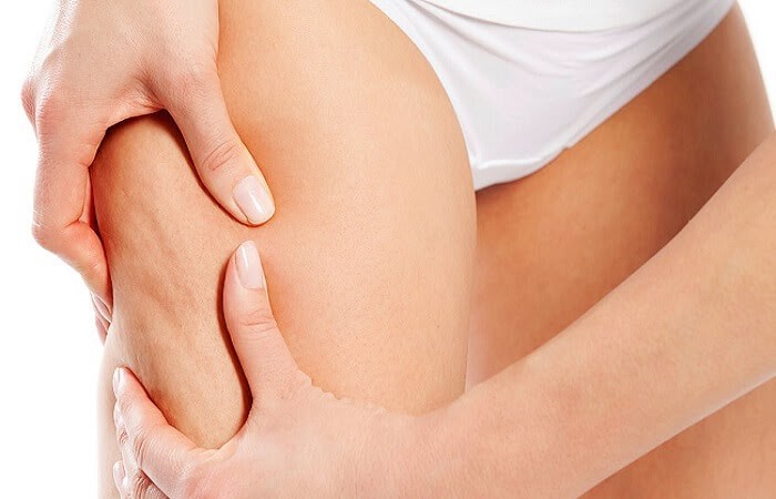 Cellulite xuất hiện chủ yếu tại các khu vực như mông hoặc mặt sau của đùi