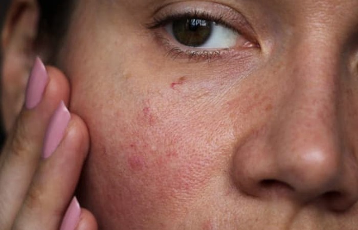 Da nhạy cảm là tình trạng làn da nổi mẩn đỏ, bong tróc, châm chích và có cảm giác căng rát sau khi tiếp xúc với các sản phẩm chăm sóc da không phù hợp