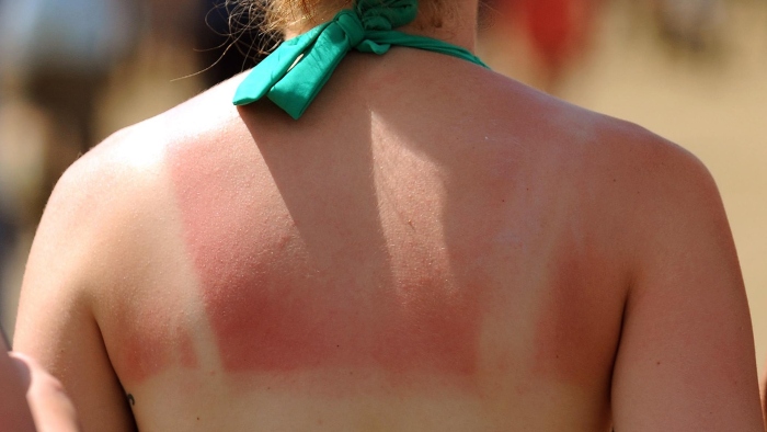 Không có biện pháp bảo vệ da trước ánh nắng mặt trời khiến da bị cháy nắng