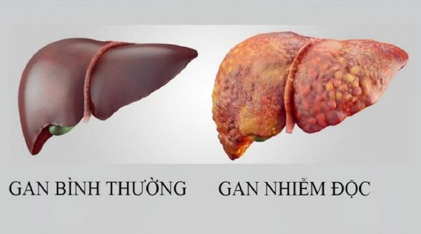Thải độc gan để có gan khỏe mạnh