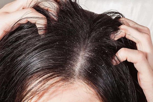 Gàu khiến da đầu luôn trong tình trạng ngứa ngáy