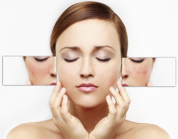 Các loại sữa rửa mặt tốt không nên có Amoni Lauryl Sulfate