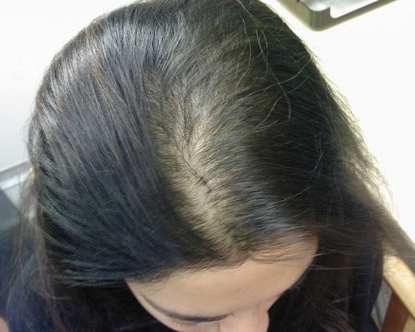 dầu gội kích thích mọc tóc áp dụng cho rụng tóc nhẹ
