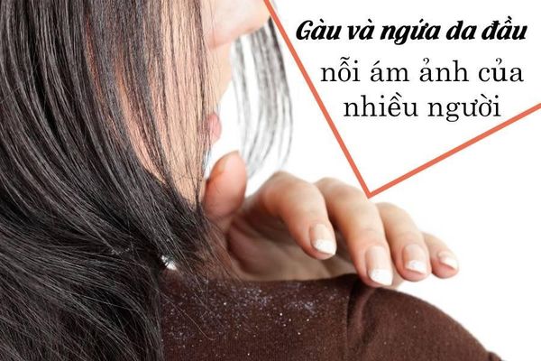 dầu gội trị gàu
