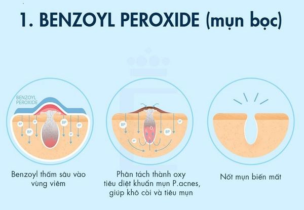  Benzoyl Peroxide hoạt động như một chất kháng khuẩn