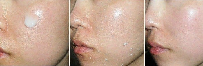 Phương pháp peeling là lựa chọn lý tưởng giúp làm sạch da nhạy cảm theo cách thức êm ái, nhẹ dịu