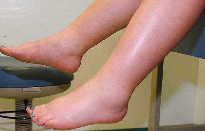 Phù chân ở người già là căn bệnh phổ biến
