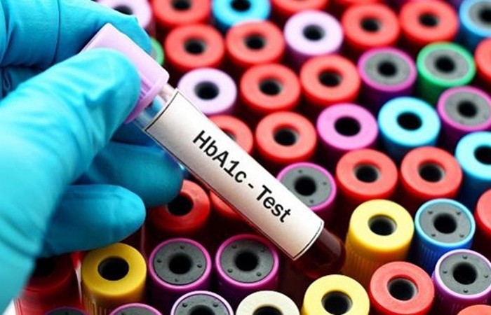 Xét nghiệm HbA1C thường được sử dụng để chẩn đoán bệnh đái tháo đường