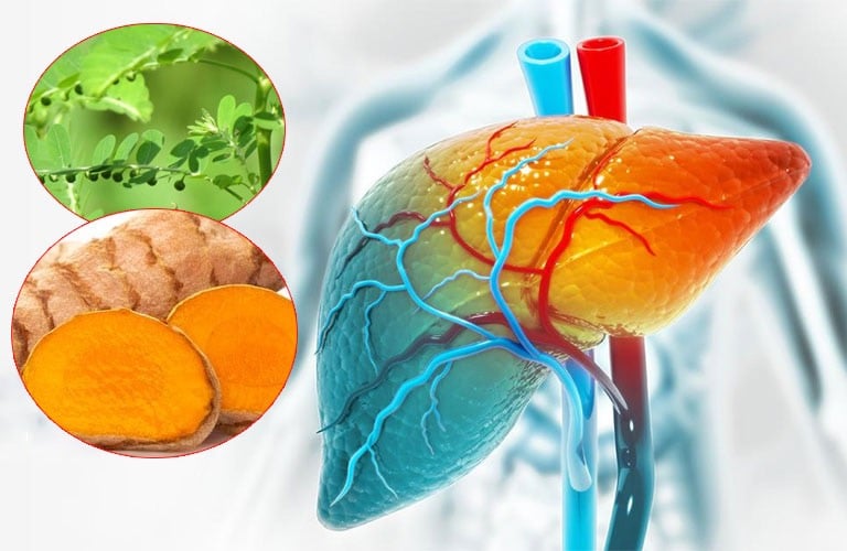 Điều trị hiệu quả gan nhiễm mỡ bằng các bài thuốc cổ phương.