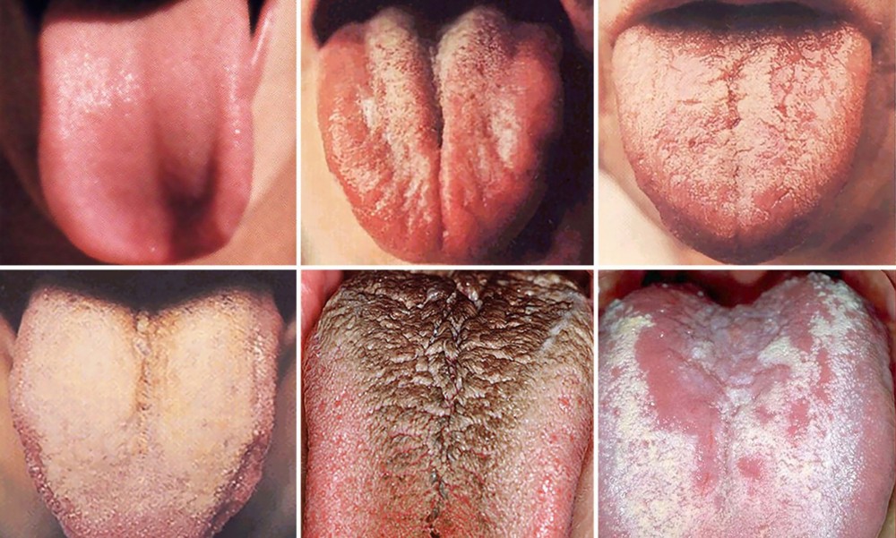 Nguyên lý chẩn bệnh qua quan sát lưỡi của Y học cổ truyền