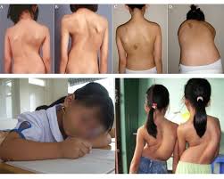 Gù vẹo cột sống: Nguyên nhân và các phương pháp trị liệu hiện nay