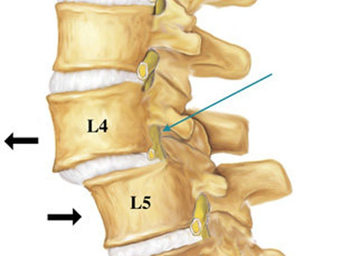Trượt đốt sống thắt lưng: Yếu tố nguy cơ, điều trị và cách phòng tránh.
