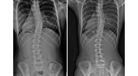 Cong vẹo cột sống: Hiểu biết để phòng ngừa và các bài tập điều trị hiệu quả