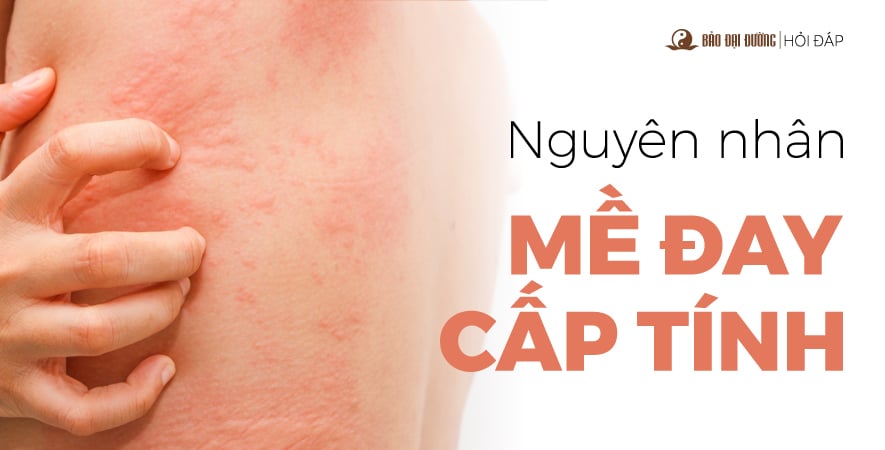 BỆNH MỀ ĐAY CẤP TÍNH