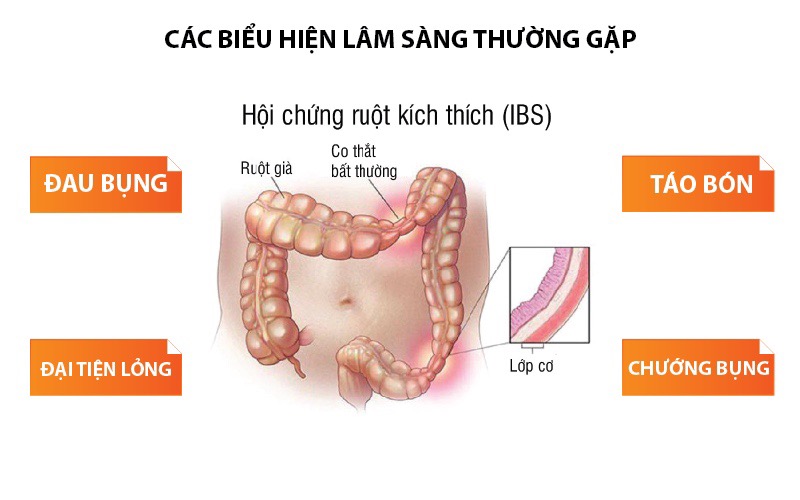 Hội chứng ruột khích thích: Điều trị hiệu quả bằng y học cổ truyền.