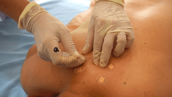 Hiểu đúng về phương pháp châm cứu chữa thoát vị đĩa đệm