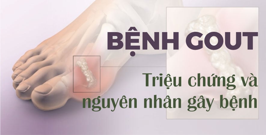 MỘT SỐ HIỂU BIẾT VỀ BỆNH GOUT