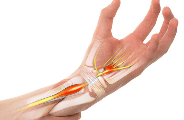 Sử dụng thuốc Đông y chữa tê bì chân tay