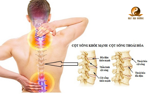 THOÁI HÓA CỘT SỐNG: NGUYÊN NHÂN VÀ CÁCH ĐIỀU TRỊ