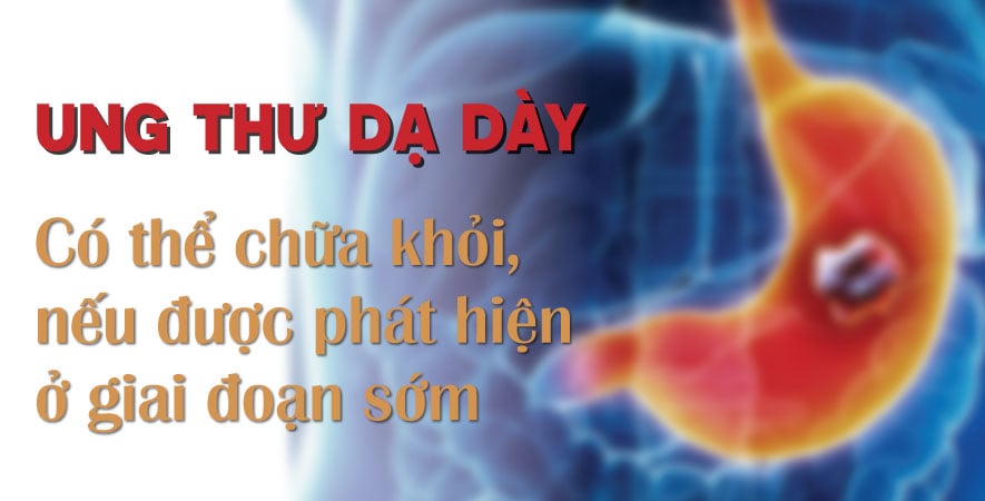 UNG THƯ DẠ DÀY LÀ BỆNH CÓ THỂ CHỮA KHỎI NẾU ĐƯỢC PHÁT HIỆN Ở GIAI ĐOẠN SỚM