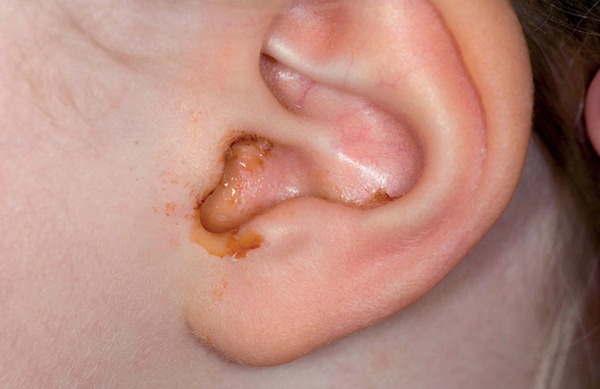 Viêm tai giữa mạn tính: Nguyên nhân, triệu chứng và cách điều trị